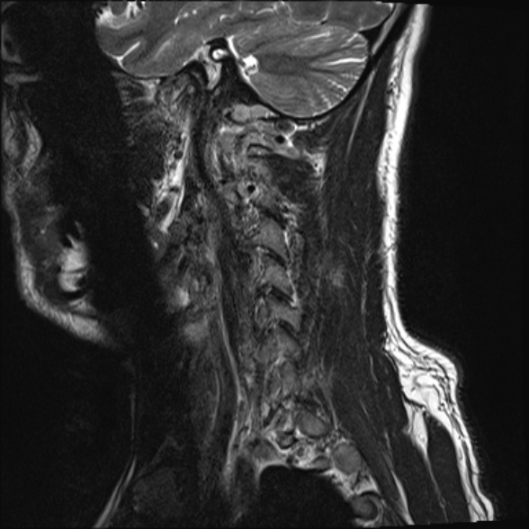 File:Cervical disc extrusion (Radiopaedia 53950-60077 Sagittal T2 3).jpg