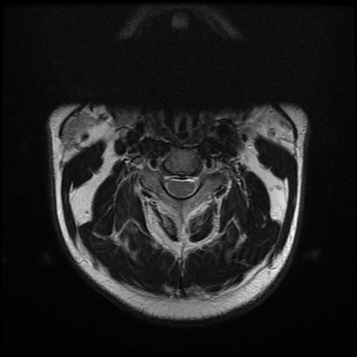 File:Cervical disc extrusion (Radiopaedia 59074-66364 Axial T2 1).jpg