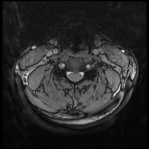 Cervical disc extrusion (Radiopaedia 59074-66364 G 43).jpg