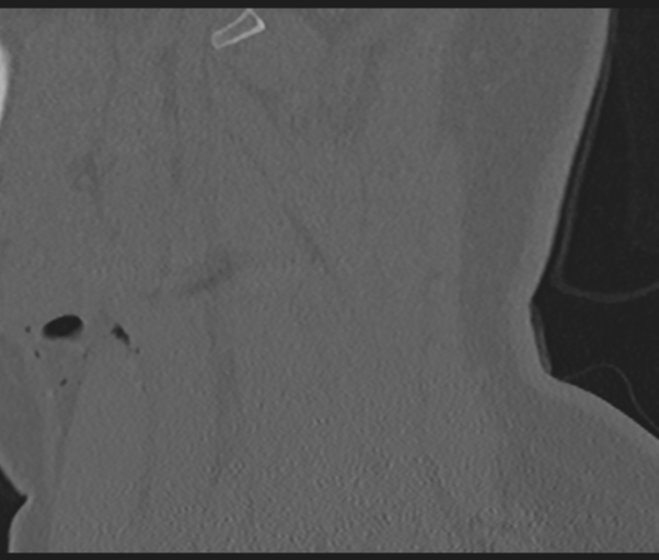 Cervical disc replacement (Radiopaedia 44025-47541 Sagittal bone window 68).png