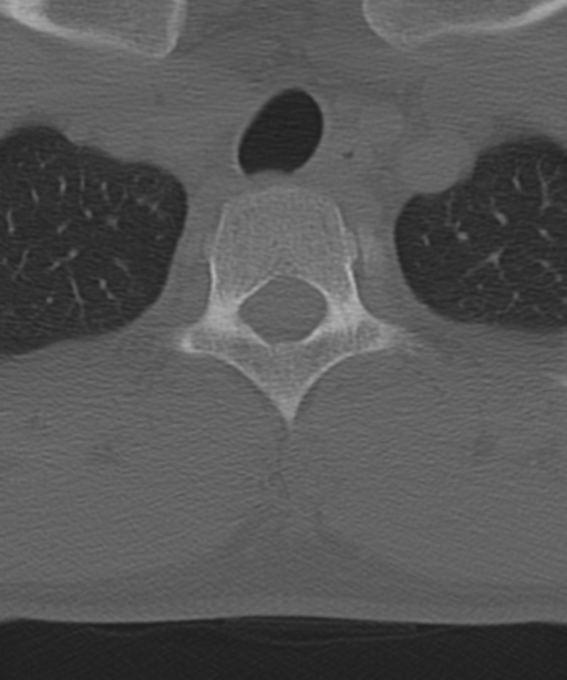 Cervical intercalary bone (Radiopaedia 35211-36748 Axial bone window 65).png