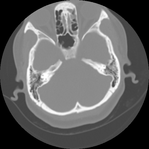File:Cervical rib (Radiopaedia 71110-81363 Axial non-contrast 6).jpg