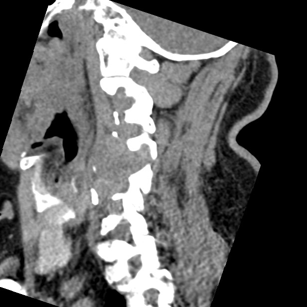 Cervical spinal neurofibroma in a patient with NF1 (Radiopaedia 58344-65464 C 18).jpg