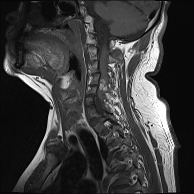 File:Cervical spinal neurofibroma in a patient with NF1 (Radiopaedia 58344-65465 Sagittal T1 3).jpg