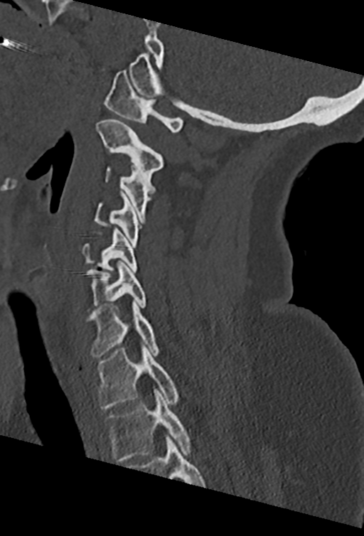 Cervical spine ACDF loosening (Radiopaedia 48998-54070 Sagittal bone window 54).png