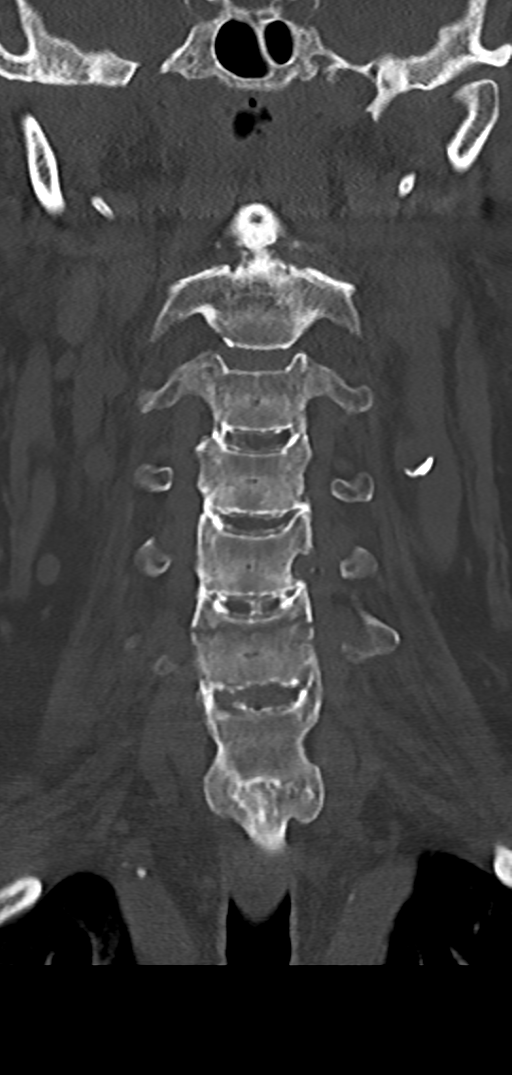 Cervical spine fracture - chalk stick (Radiopaedia 39116-41323 Coronal bone window 18).png