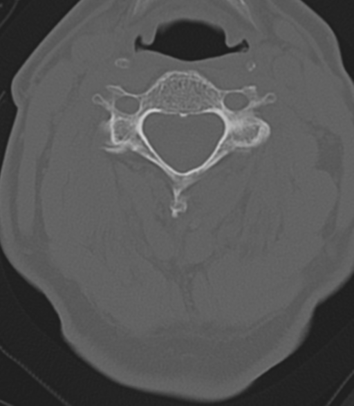 File:Cervical spine fractures with vertebral artery dissection (Radiopaedia 53296-59268 Axial bone window 27).png