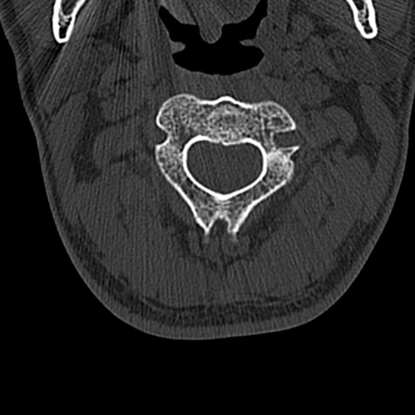 Cervical spondylodiscitis (Radiopaedia 28057-29489 Axial bone window 26).jpg