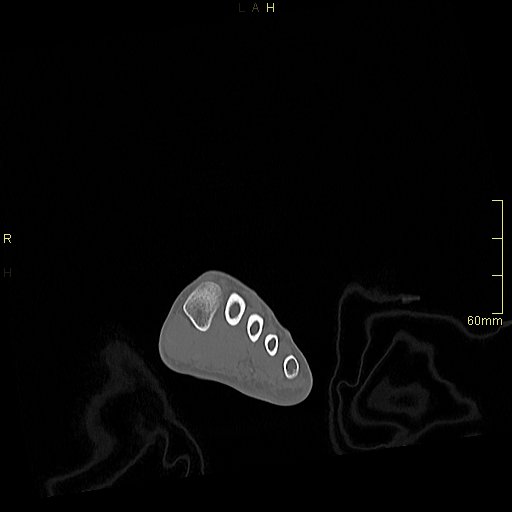 File:Chaput tubercle fracture (Radiopaedia 80319-93956 Coronal non-contrast 1).jpg