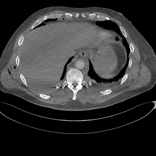 File:Chest multitrauma - aortic injury (Radiopaedia 34708-36147 A 247).png
