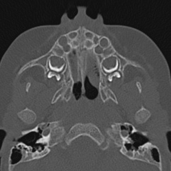 Choanal atresia (Radiopaedia 88525-105975 Axial bone window 18).jpg