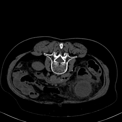 File:Cholecystitis - obstructive choledocholitiasis (CT intravenous cholangiography) (Radiopaedia 43966-47479 Axial 56).png