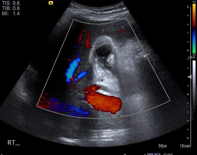 File:Cholecystitis - perforated gallbladder (Radiopaedia 57038-63913 A 33).jpg