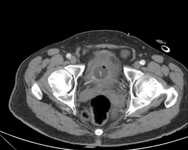 Cholecystitis - perforated gallbladder (Radiopaedia 57038-63916 A 78).jpg