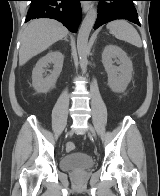 Cholecystitis with focal perforation and hepatic abscess (Radiopaedia 37189-38945 Coronal non-contrast 37).png