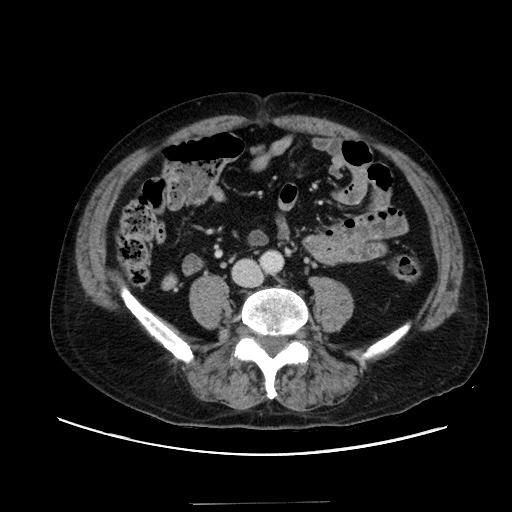 Choledocholiathiasis with normal caliber common bile duct (Radiopaedia 75368-86632 A 119).jpg