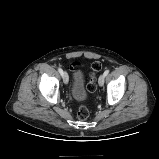 Choledocholiathiasis with normal caliber common bile duct (Radiopaedia 75368-86632 A 168).jpg