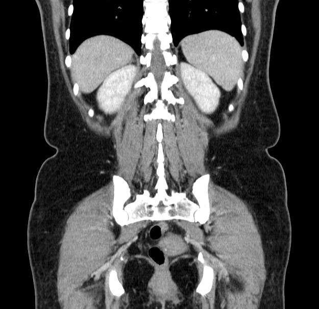 Choledocholithiasis on CT and MRI (Radiopaedia 24825-25087 C 41).jpg