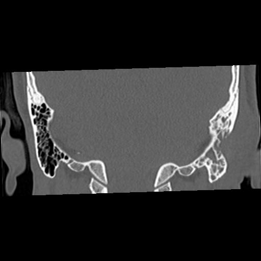 Cholesteatoma (Radiopaedia 84960-100474 Coronal bone window 50).jpg