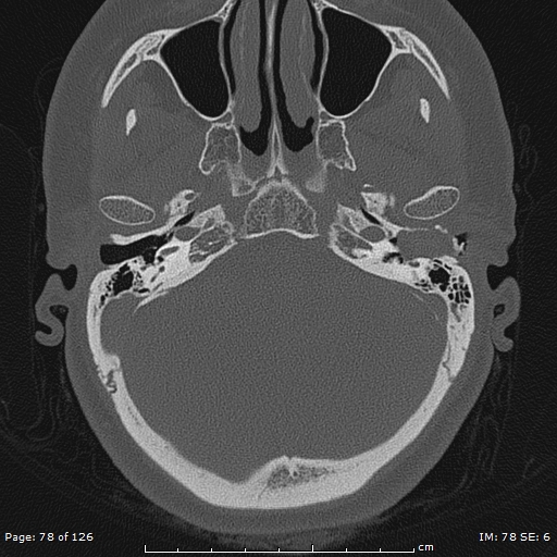 Cholesteatoma - external auditory canal (Radiopaedia 88452-105096 Axial bone window 41).jpg