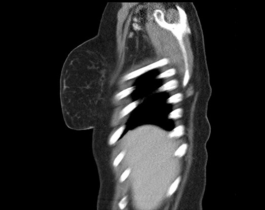 Chondrosarcoma - chest wall (Radiopaedia 65192-74199 B 53).jpg