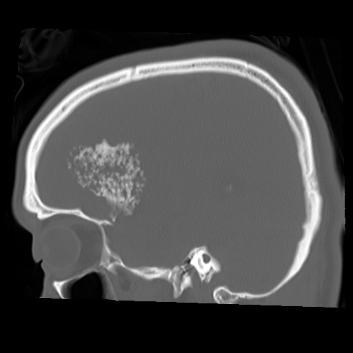 File:Chondrosarcoma - sphenoid wing (Radiopaedia 58259-67828 Sagittal bone window 21).jpg