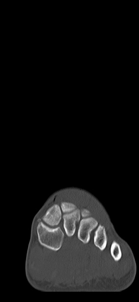 Chopart fracture (Radiopaedia 35347-36851 Coronal bone window 58).jpg