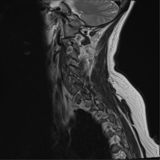 File:Chordoma (C4 vertebra) (Radiopaedia 47561-52189 Sagittal T2 13).png