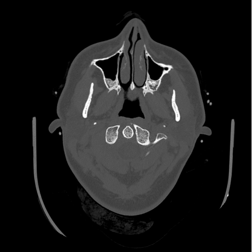 Choroid plexus papilloma extending into the cerebellopontine angle cistern (Radiopaedia 85941-101833 Axial bone window 9).png