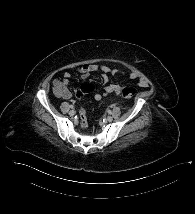 Chromophobe renal cell carcinoma (Radiopaedia 84239-99519 E 121).jpg
