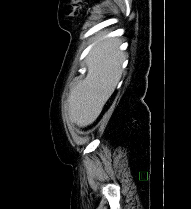 Chromophobe renal cell carcinoma (Radiopaedia 84239-99519 G 104).jpg