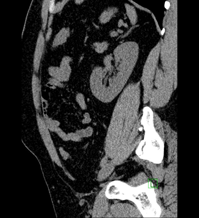 Chromophobe renal cell carcinoma (Radiopaedia 84286-99573 C 53).jpg