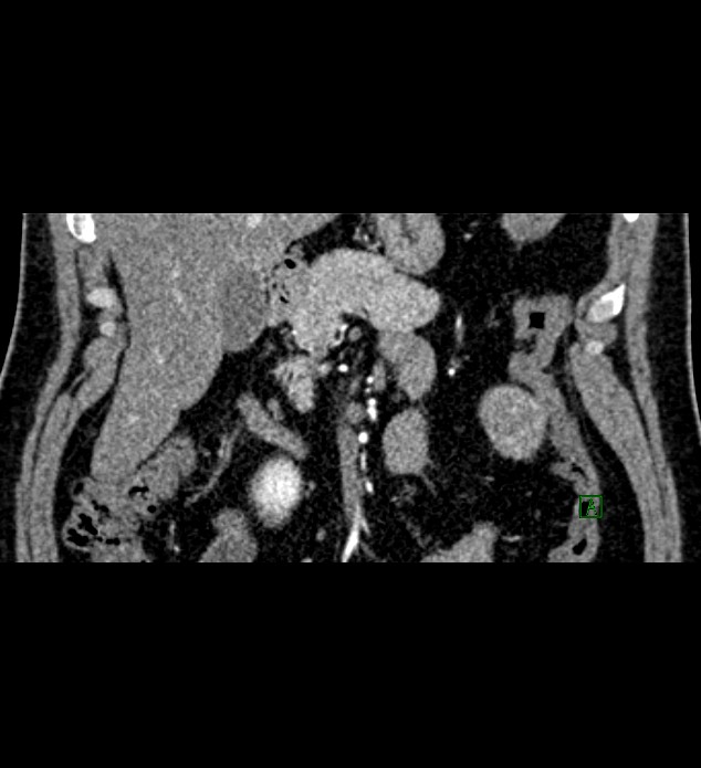 Chromophobe renal cell carcinoma (Radiopaedia 84286-99573 E 11).jpg