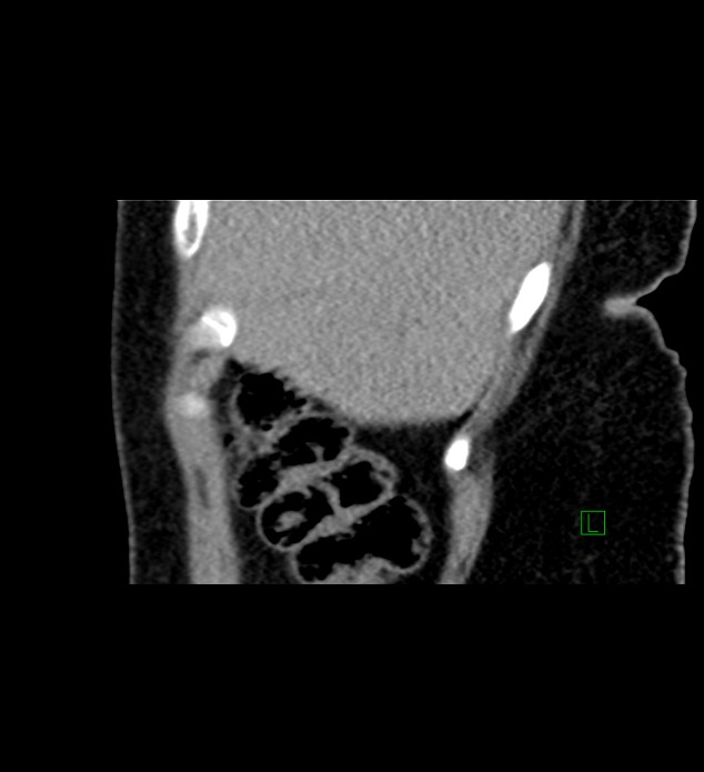Chromophobe renal cell carcinoma (Radiopaedia 84290-99582 D 85).jpg