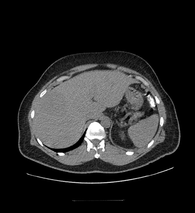 Chromophobe renal cell carcinoma (Radiopaedia 84337-99644 Axial non-contrast 19).jpg