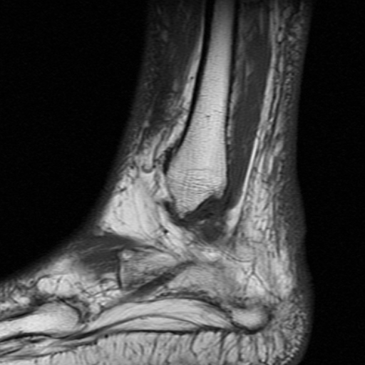 File:Chronic Achilles tendon rupture (Radiopaedia 15262-15100 Sagittal T1 1).jpg