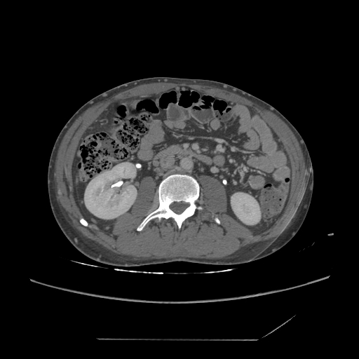 File:Chronic IVC thrombosis and resultant IVC filter malposition (Radiopaedia 81158-94800 A 105).jpg