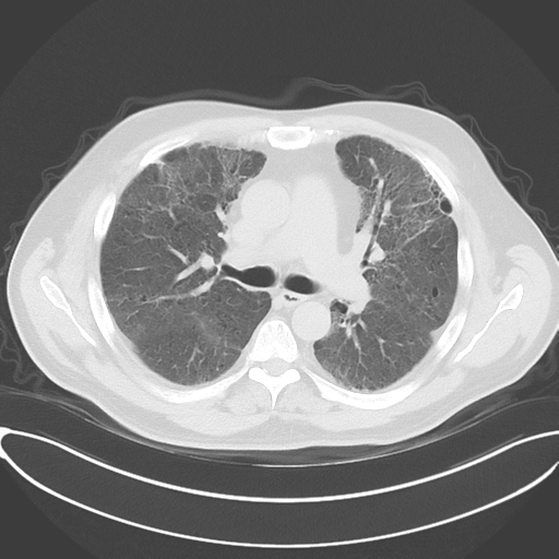 Chronic hypersensitivity pneumonitis (Radiopaedia 48107-52922 Axial lung window 28).png