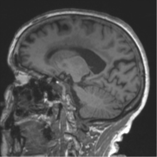 File:Chronic hypertensive encephalopathy (Radiopaedia 39993-42482 Sagittal T1 40).png