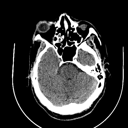Chronic invasive fungal sinusitis (Radiopaedia 91563-109286 Axial non-contrast 28).jpg