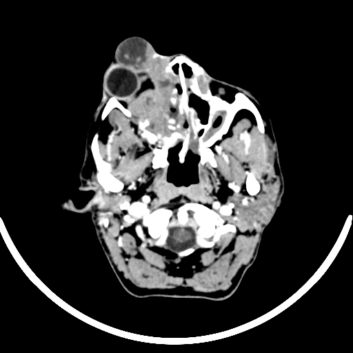 Chronic invasive fungal sinusitis with intraorbital and intracranial extension (Radiopaedia 56387-63046 B 59).jpg