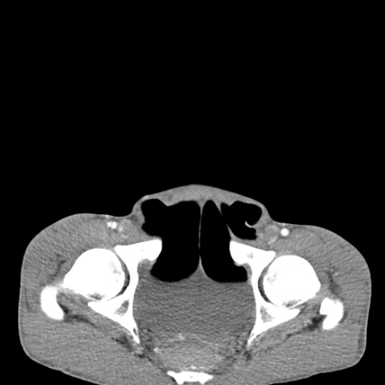 Chronic large bowel pseudo-obstruction (Radiopaedia 43181-46492 A 156).jpg