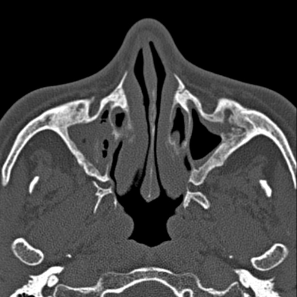 Chronic maxillary sinusitis (Radiopaedia 27879-28116 Axial bone window 17).jpg