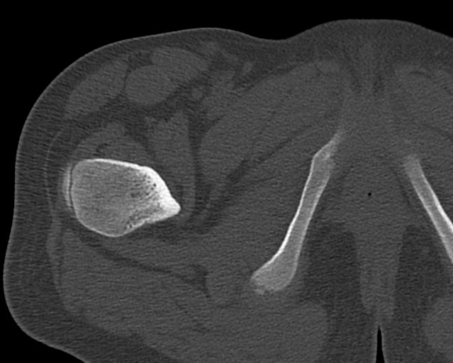 Chronic ostemyelitis of the femur with long sinus tract (Radiopaedia 74947-85982 Axial bone window 17).jpg