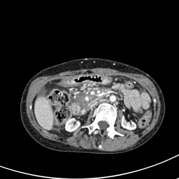 Chronic pancreatitis (Radiopaedia 55405-61846 A 45).jpg