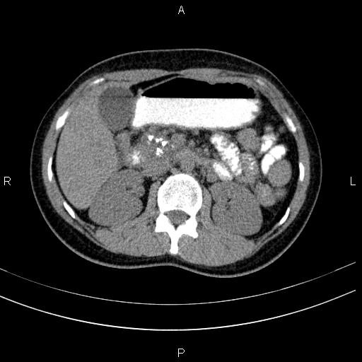 File:Chronic pancreatitis (Radiopaedia 64576-73450 Axial non-contrast 58).jpg