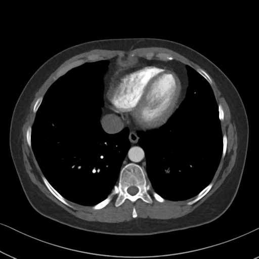 Chronic pulmonary embolus (Radiopaedia 39129-41341 Axial C+ CTPA 76).png