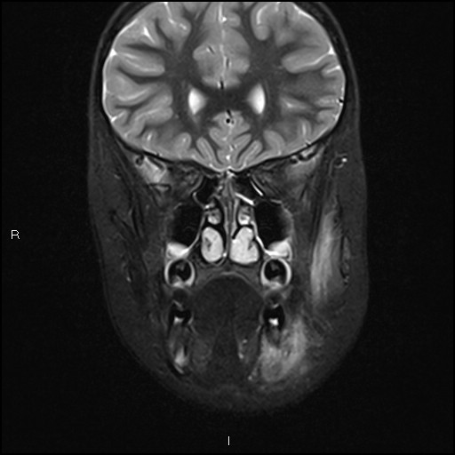 File:Chronic reactive multifocal osteomyelitis (CRMO) - mandible (Radiopaedia 56405-63069 Coronal STIR 13).jpg