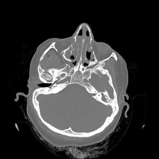 Chronic sinusitis with intra-sinus calcification (Radiopaedia 63919-72668 Axial bone window 34).jpg