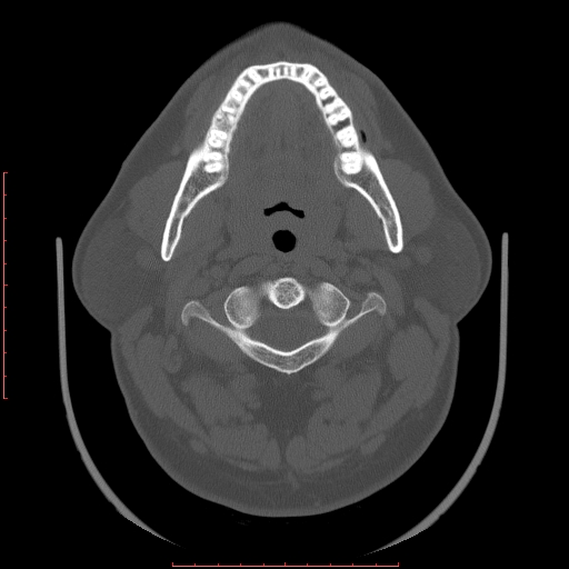File:Chronic submandibular sialolithiasis (Radiopaedia 69817-79814 Axial bone window 41).jpg